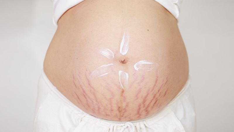 Giai đoạn mang thai tháng thứ 5, nhiều bà bầu xuất hiện các vết rạn da ở vùng bụng