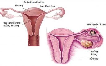 Thai ngoài tử cung là do trứng không thể di chuyển đến lòng tử cung
