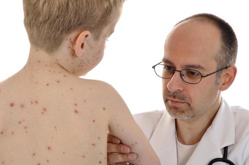 Các dấu hiệu nhận biết bệnh thuỷ đậu ở trẻ em