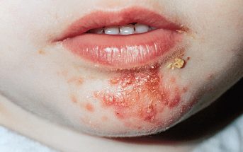 Bệnh chốc ở trẻ em rất dễ lây nhiễm