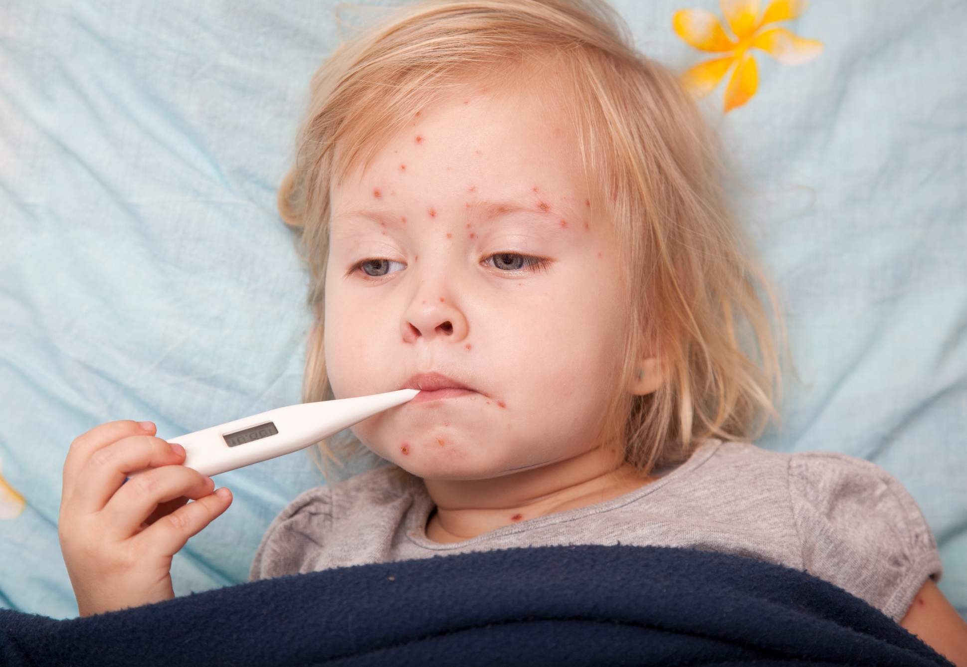 Bệnh thủy đậu ở trẻ em hay phỏng rạ do vi rút Varicella zoster gây ra