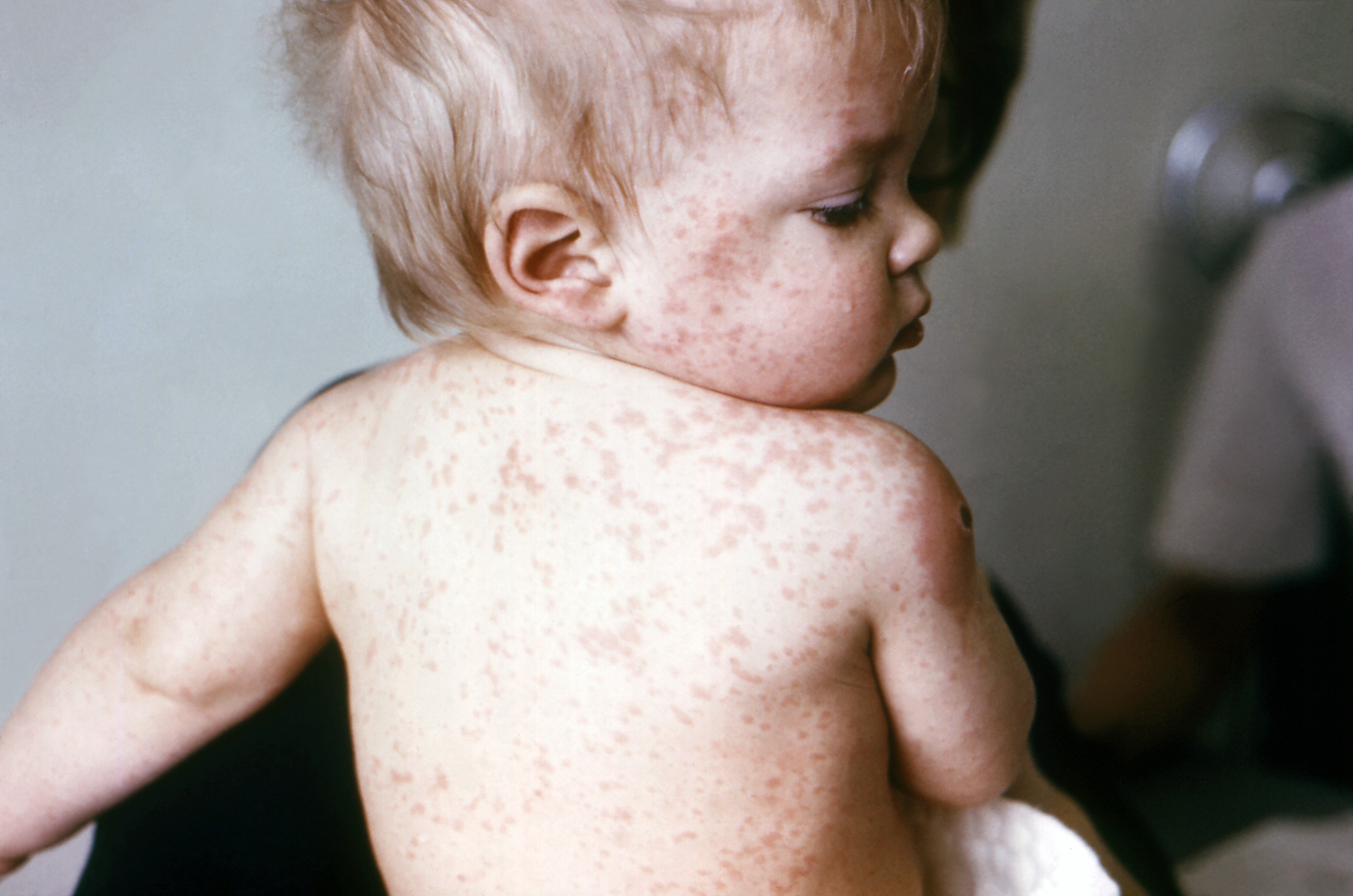 Các triệu chứng bệnh sởi ở trẻ em là sốt nhẹ hoặc sốt cao từ 39 - 400C, sốt liên tục